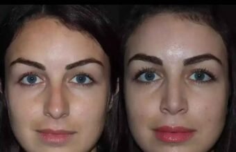 Septoplasty in Dubai
