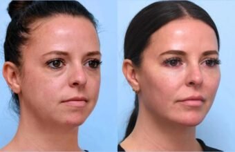 Thread lift in Dubai for Comprehensive Non Surgical Rejuvenation