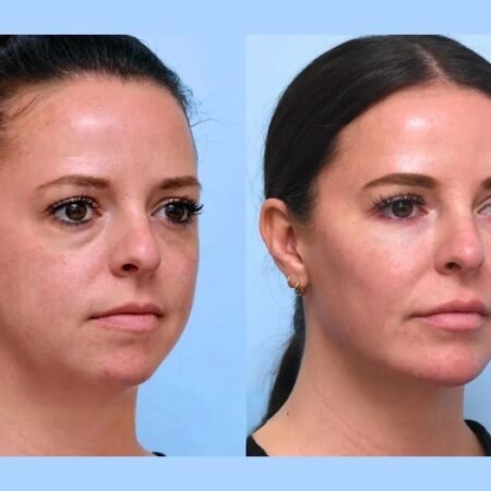 Thread lift in Dubai for Comprehensive Non Surgical Rejuvenation