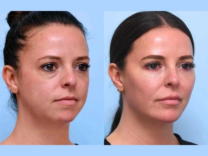 Thread lift in Dubai for Comprehensive Non Surgical Rejuvenation