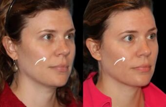sculptra fillers in dubai
