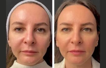 Mesotherapy in Dubai