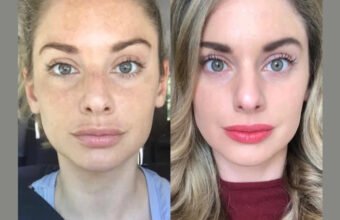 Radiofrequency (RF) Microneedling in Dubai