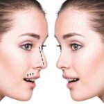 Rhinoplasty in Dubai