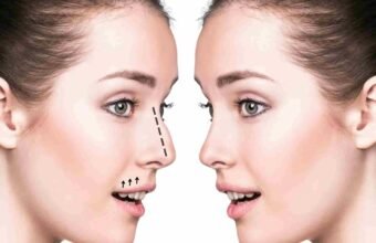 Rhinoplasty in Dubai