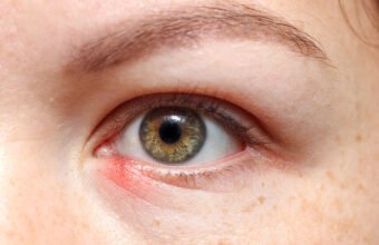 Wholesale Stye Treatment UK for Pharmacies and Clinics
