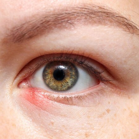Wholesale Stye Treatment UK for Pharmacies and Clinics