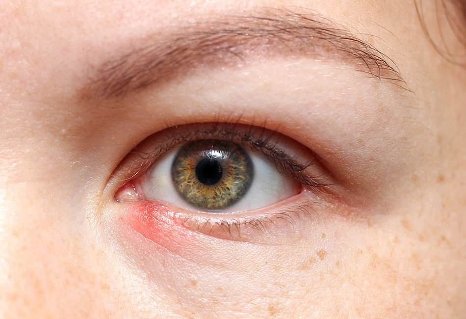 Wholesale Stye Treatment UK for Pharmacies and Clinics