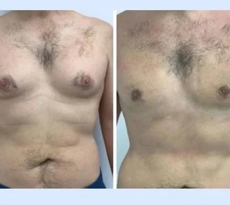 gynecomastia in dubai